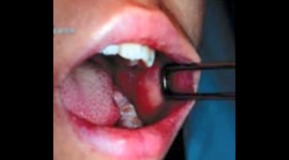 　『はしか』の感染力はインフルの10倍「最強クラス」　「今、ワクチン供給量は十分」必要であれば大人も接種を　福岡でも今年初の感染者