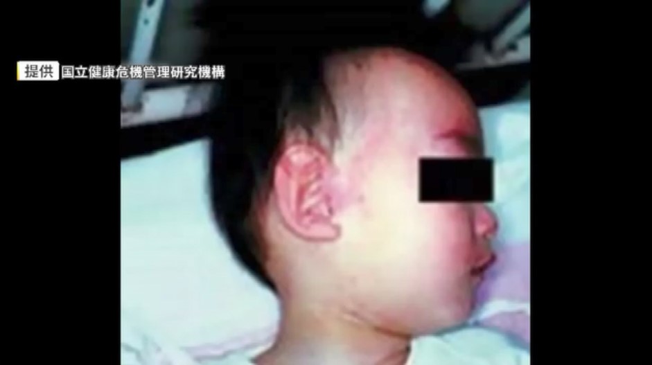 ワクチン接種歴2回あるのに感染か　福岡県内で今年3人目の「はしか」患者　海外渡航歴なしの20代女性