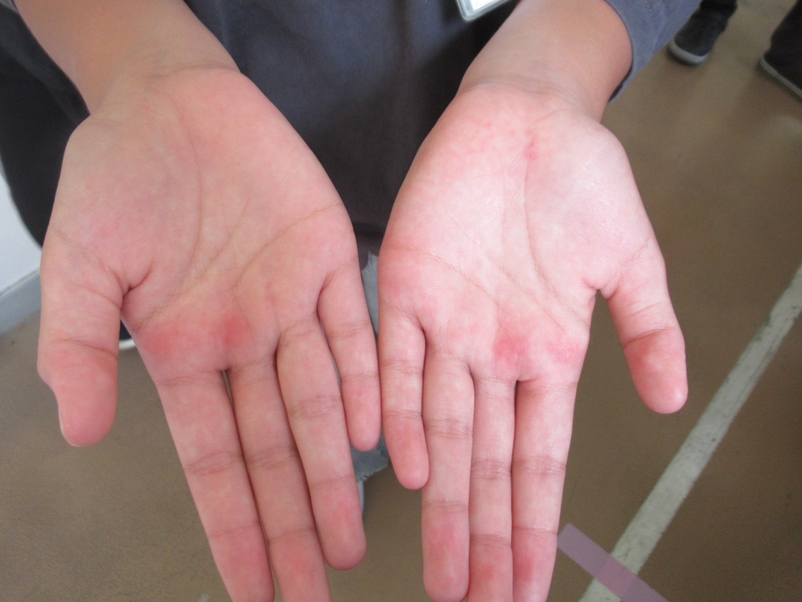 手の湿疹は「マットによる圧迫痕」市教委が最終結論 プール開きで小学生25人救急搬送 医師の見解も踏まえ判断 福岡・北九州市